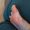 Close-up of a soft callus on a foot of a woman, sport shoes problem, corn on the leg. blister on the feet . High quality photo