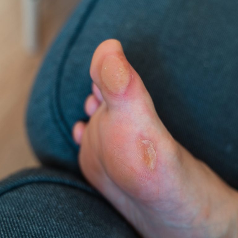 Close-up of a soft callus on a foot of a woman, sport shoes problem, corn on the leg. blister on the feet . High quality photo